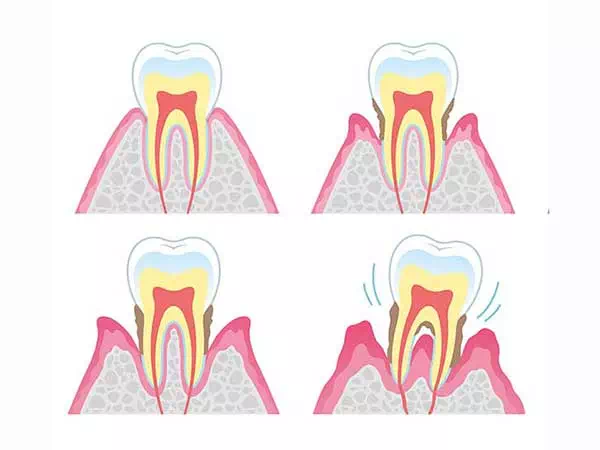 Progressione-della-parodontite-sui-denti