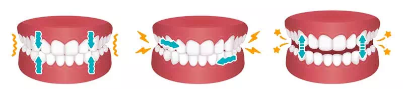 Tipologie di bruxismo Digrignamento - sfregamento - sbattimento dei denti 