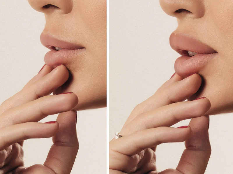 trattamento-filler-labbra-a-milano